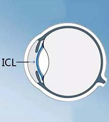 ICL晶体