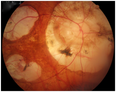 验光前为什么让孩子查眼底？——